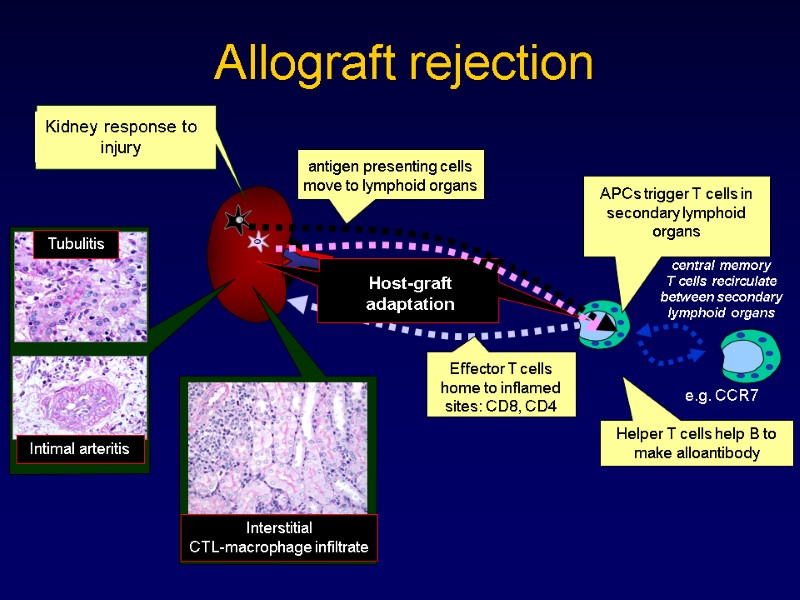 Allograft rejection Helper T cells help B to make alloantibody APCs trigger T cells